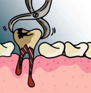 Можно ли алкоголь после удаления зуба