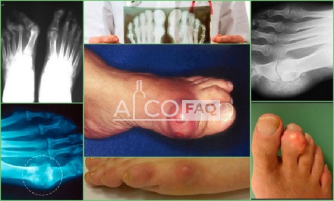 Какой алкоголь можно пить при подагре