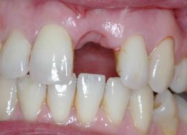 Можно ли алкоголь после удаления зуба