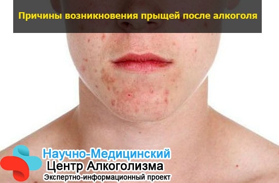 Если появились прыщи от алкоголя