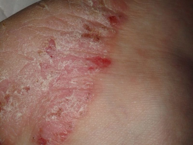 Можно ли употреблять траву кукольник от алкоголизма