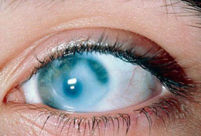 Признаки отравления метилом