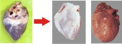 Алкогольная кардиомиопатия