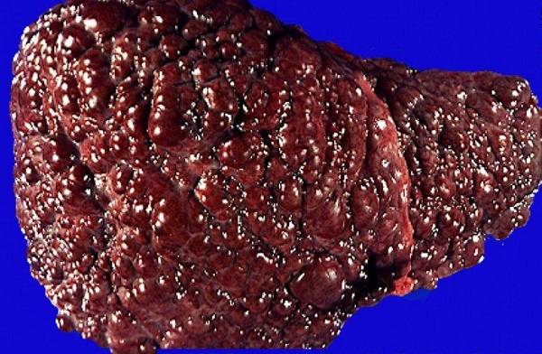 Жизнь при алкогольном гепатите