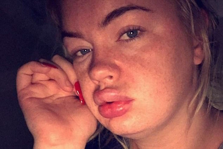 Если красные глаза и отеки после алкоголя