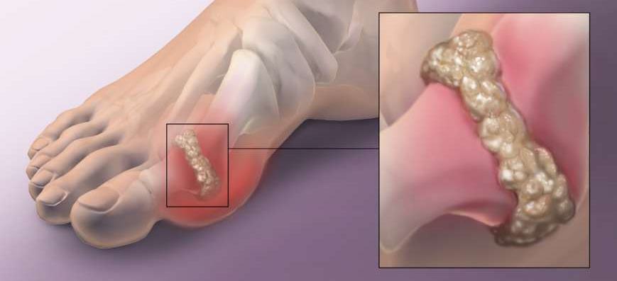 Какой алкоголь можно пить при подагре