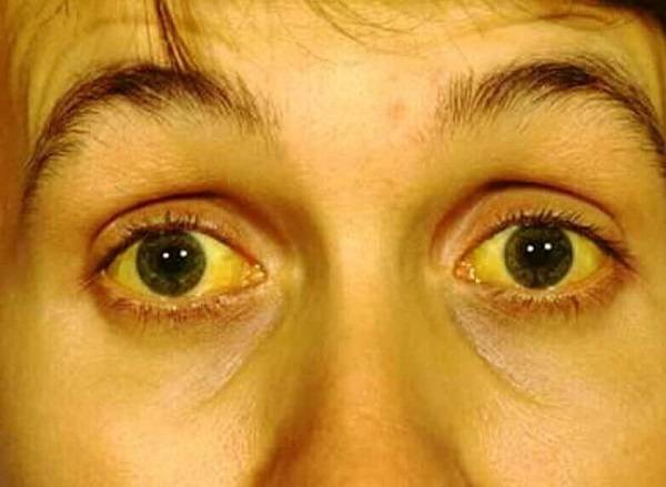 Жизнь при алкогольном гепатите